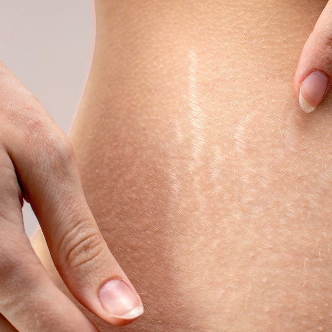 Embracing Your Body: Understanding Stretch Marks, Causes, Treatment Options, and Cultivating Body Confidence